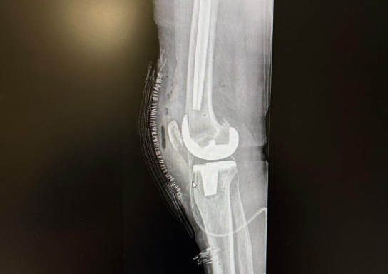 What Are the Language Needs for Healthcare Tourists and Their Providers